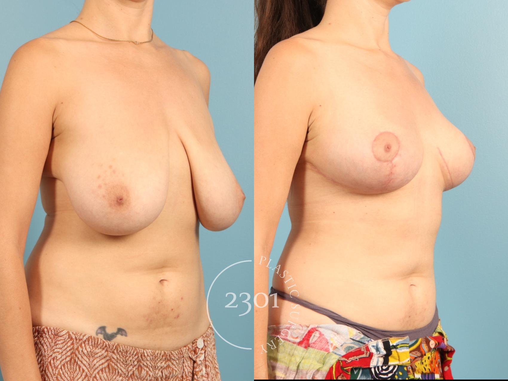 Before & After Breast Lift (Mastopexy) Case 967 Left Oblique View in Fort Worth, Plano, & Frisco, Texas