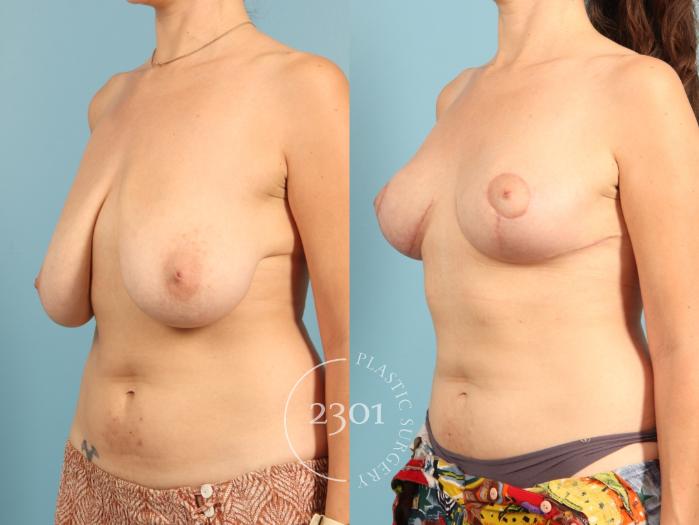 Before & After Breast Lift (Mastopexy) Case 967 Right Oblique View in Fort Worth, Plano, & Frisco, Texas