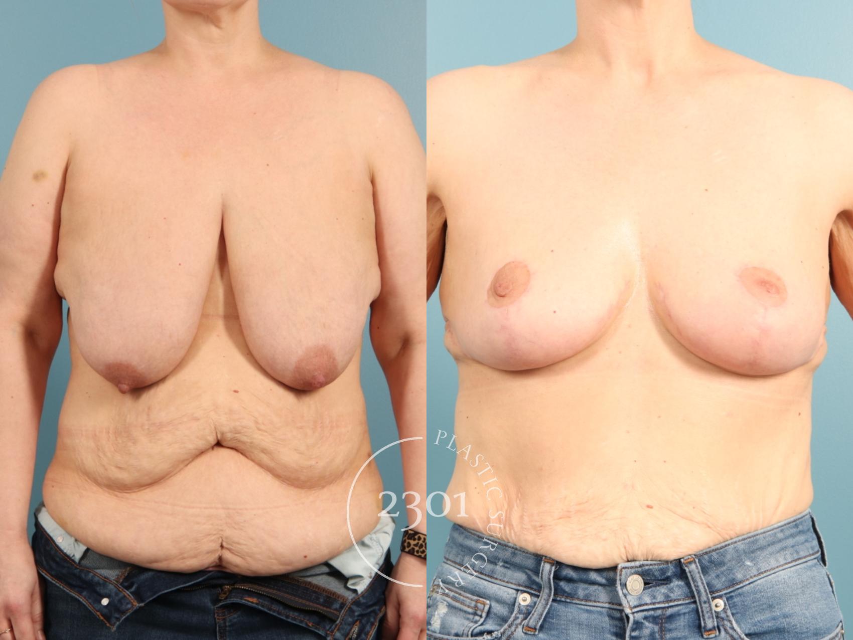 Before & After Breast Lift (Mastopexy) Case 968 Front View in Fort Worth, Plano, & Frisco, Texas