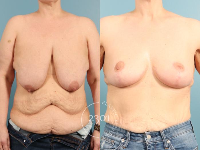 Before & After Breast Lift (Mastopexy) Case 968 Front View in Fort Worth, Plano, & Frisco, Texas