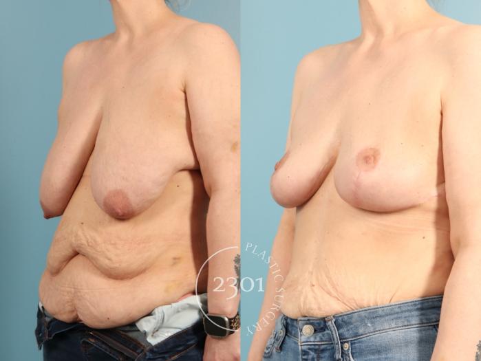 Before & After Breast Lift (Mastopexy) Case 968 Left Oblique View in Fort Worth, Plano, & Frisco, Texas