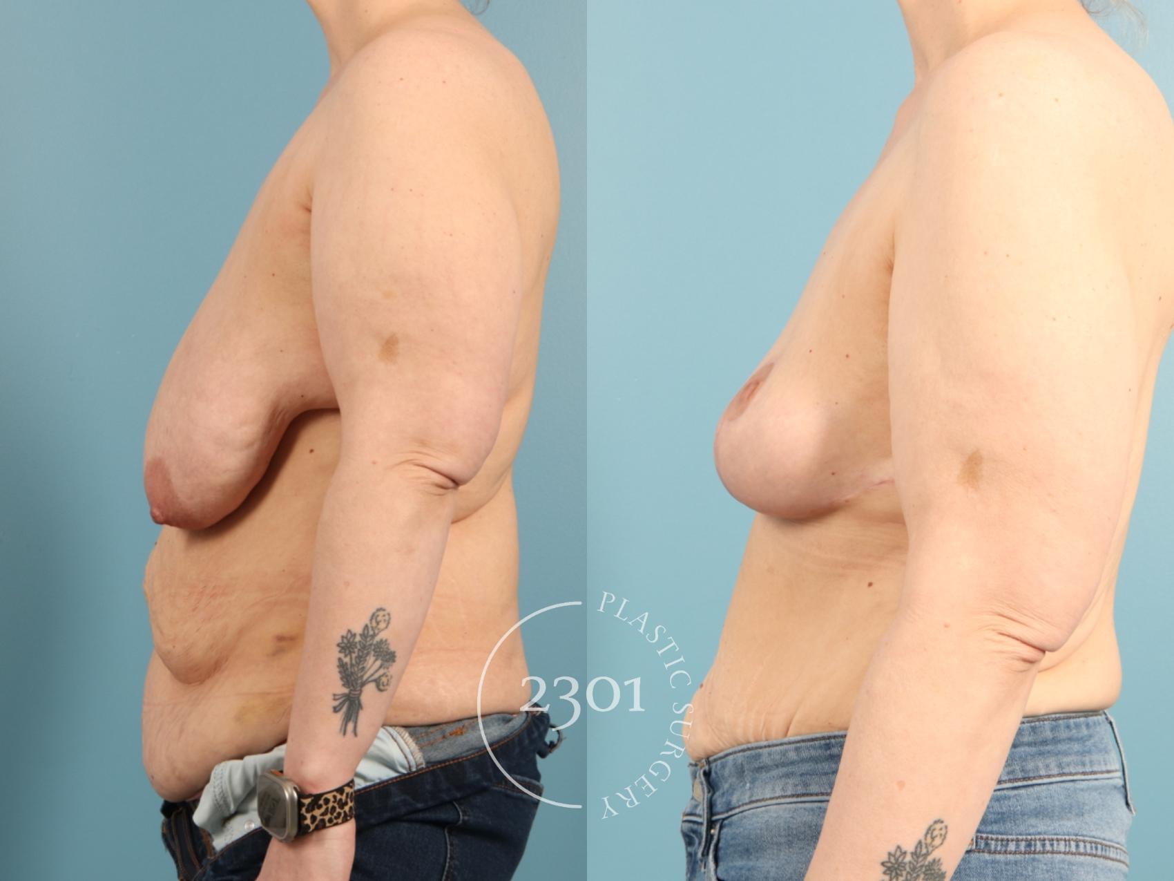 Before & After Breast Lift (Mastopexy) Case 968 Left Side View in Fort Worth, Plano, & Frisco, Texas