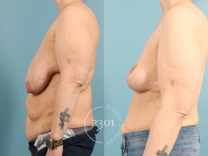 Before & After Breast Lift (Mastopexy) Case 968 Left Side View in Fort Worth, Plano, & Frisco, Texas