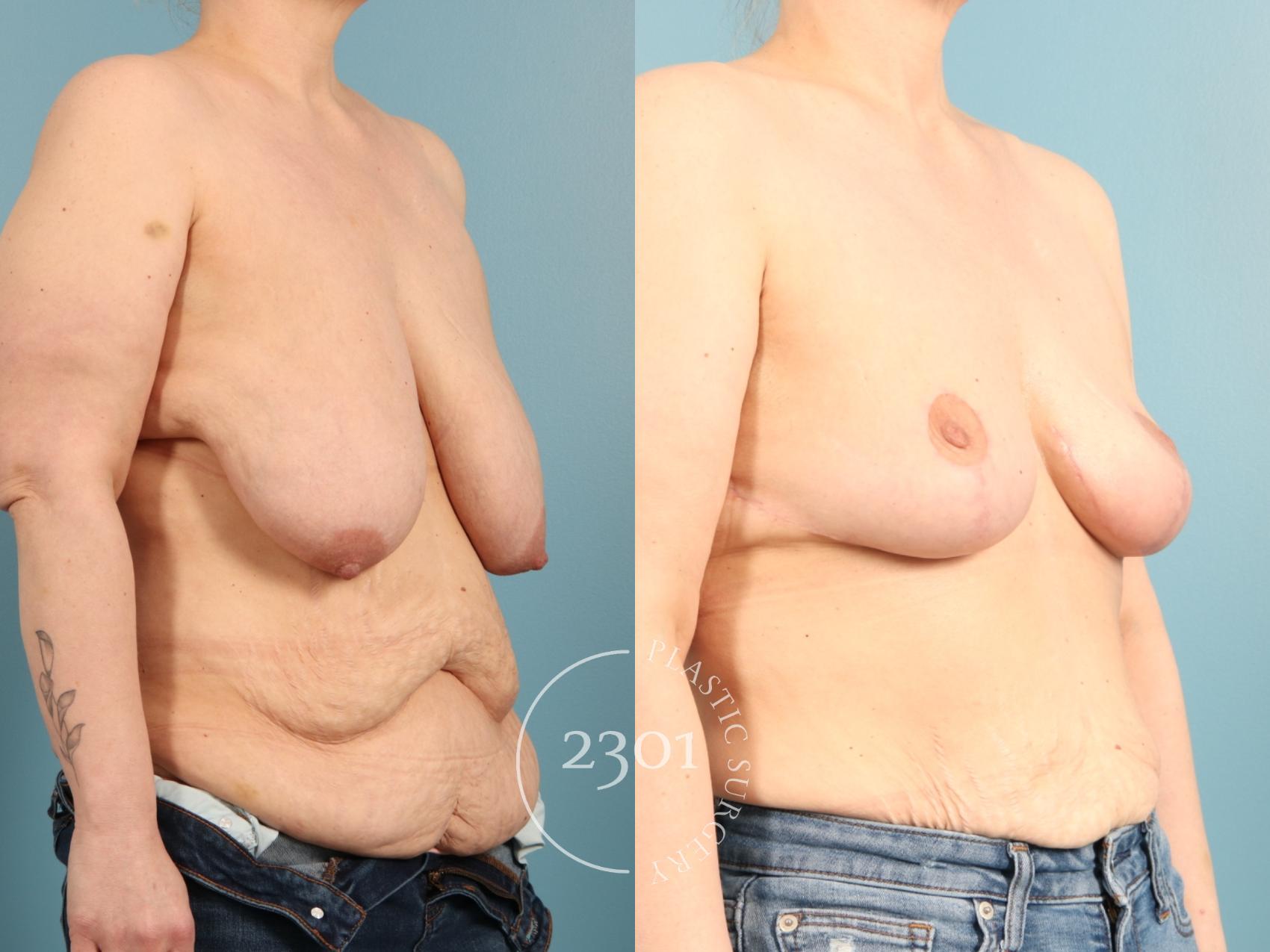 Before & After Breast Lift (Mastopexy) Case 968 Right Oblique View in Fort Worth, Plano, & Frisco, Texas