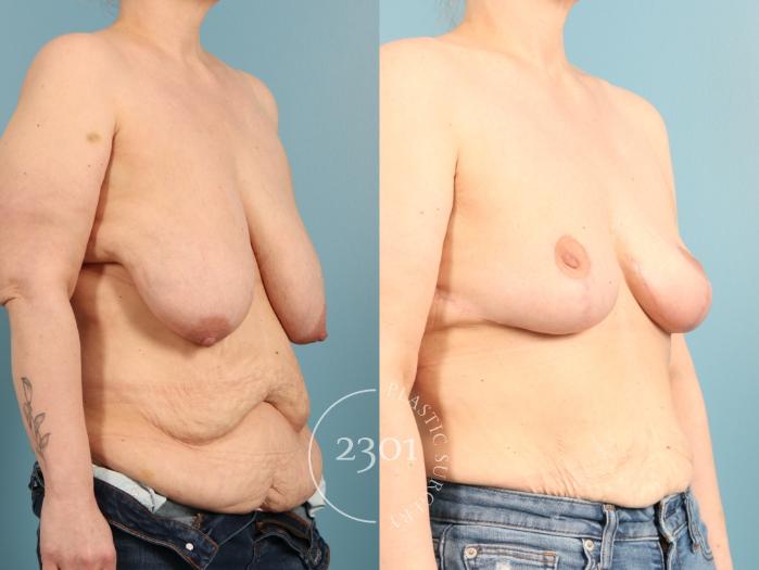 Before & After Breast Lift (Mastopexy) Case 968 Right Oblique View in Fort Worth, Plano, & Frisco, Texas