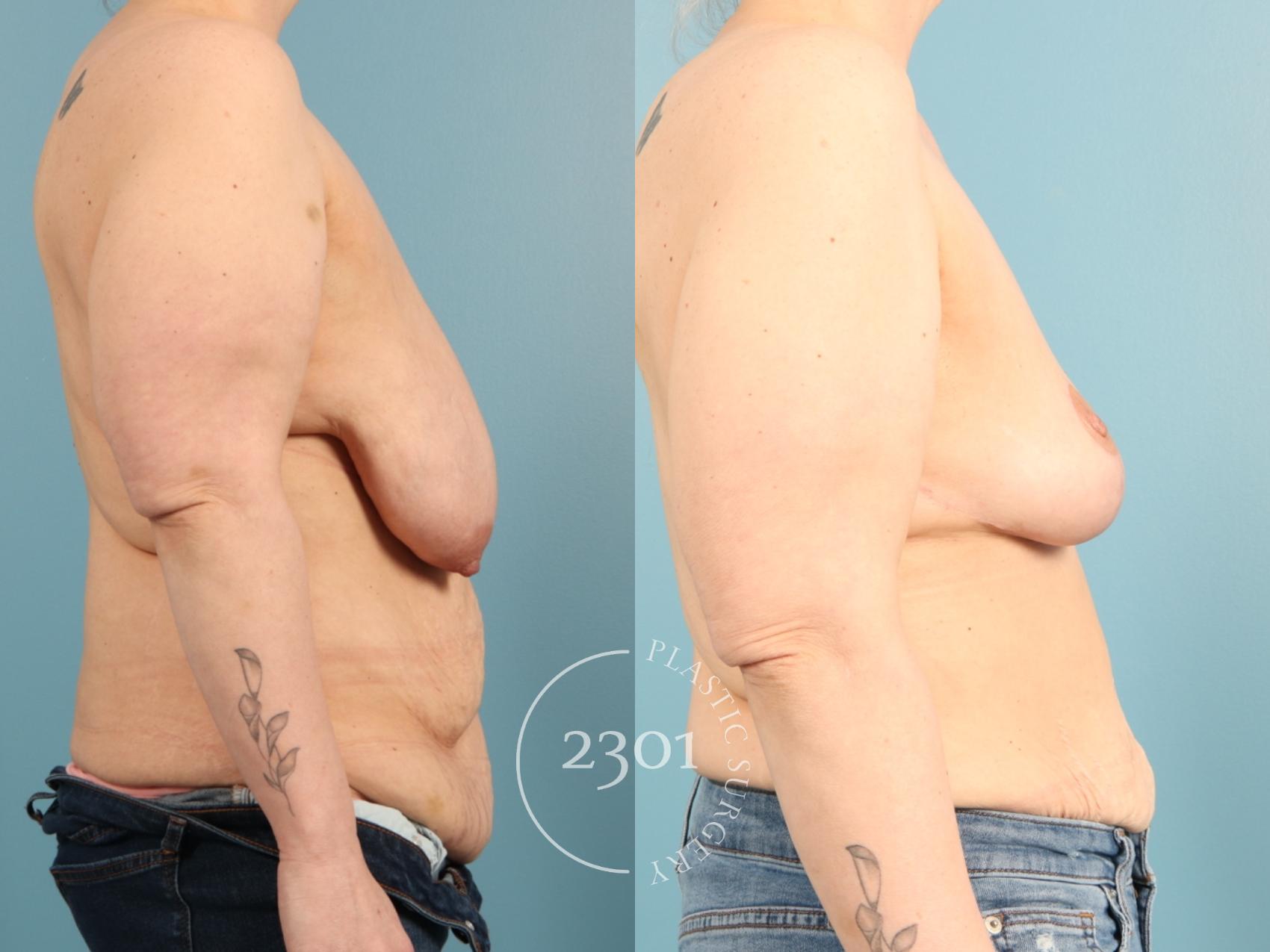 Before & After Breast Lift (Mastopexy) Case 968 Right Side View in Fort Worth, Plano, & Frisco, Texas