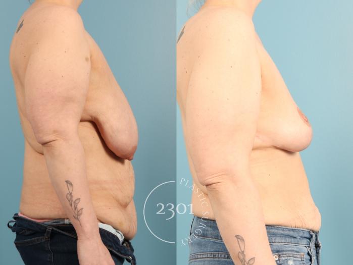 Before & After Breast Lift (Mastopexy) Case 968 Right Side View in Fort Worth, Plano, & Frisco, Texas