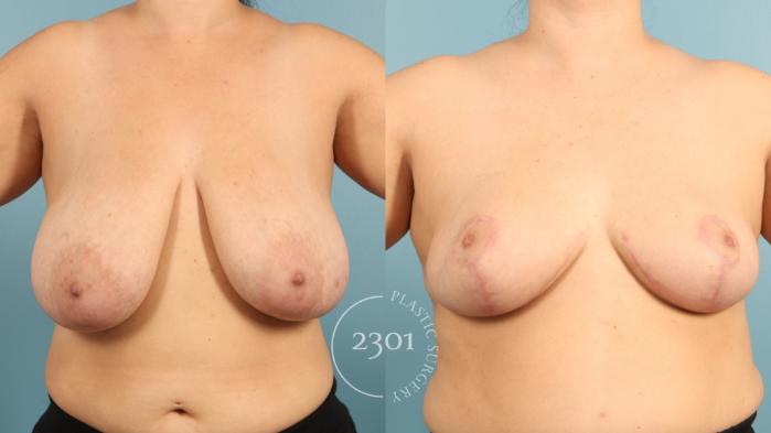 Before & After Breast Lift (Mastopexy) Case 969 Front View in Fort Worth, Plano, & Frisco, Texas