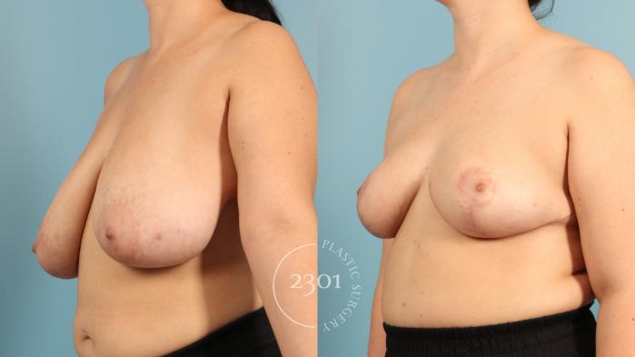Before & After Breast Lift (Mastopexy) Case 969 Left Oblique View in Fort Worth, Plano, & Frisco, Texas
