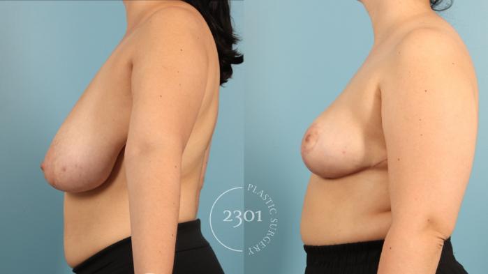 Before & After Breast Lift (Mastopexy) Case 969 Left Side View in Fort Worth, Plano, & Frisco, Texas