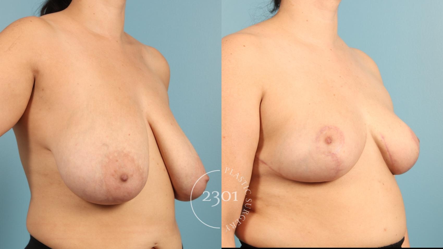 Before & After Breast Lift (Mastopexy) Case 969 Right Oblique View in Fort Worth, Plano, & Frisco, Texas