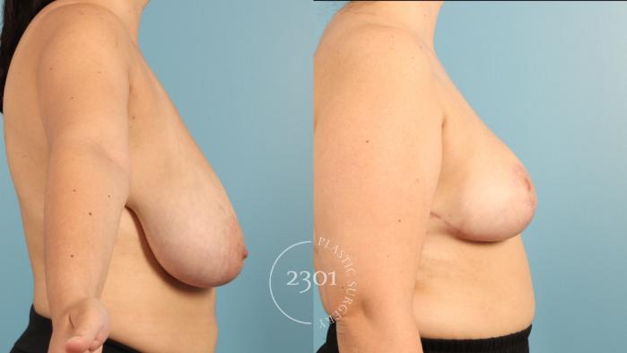 Before & After Breast Lift (Mastopexy) Case 969 Right Side View in Fort Worth, Plano, & Frisco, Texas