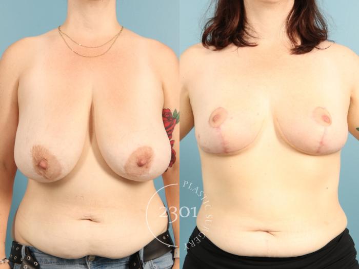 Before & After Breast Lift (Mastopexy) Case 971 Front View in Fort Worth, Plano, & Frisco, Texas