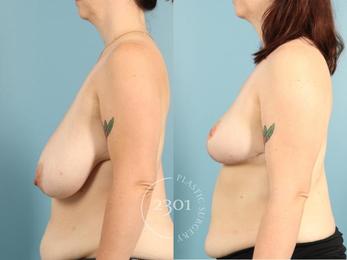Before & After Breast Lift (Mastopexy) Case 971 Left Side View in Fort Worth, Plano, & Frisco, Texas