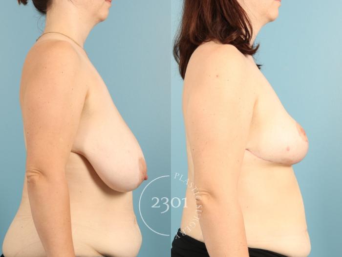 Before & After Breast Lift (Mastopexy) Case 971 Right Side View in Fort Worth, Plano, & Frisco, Texas