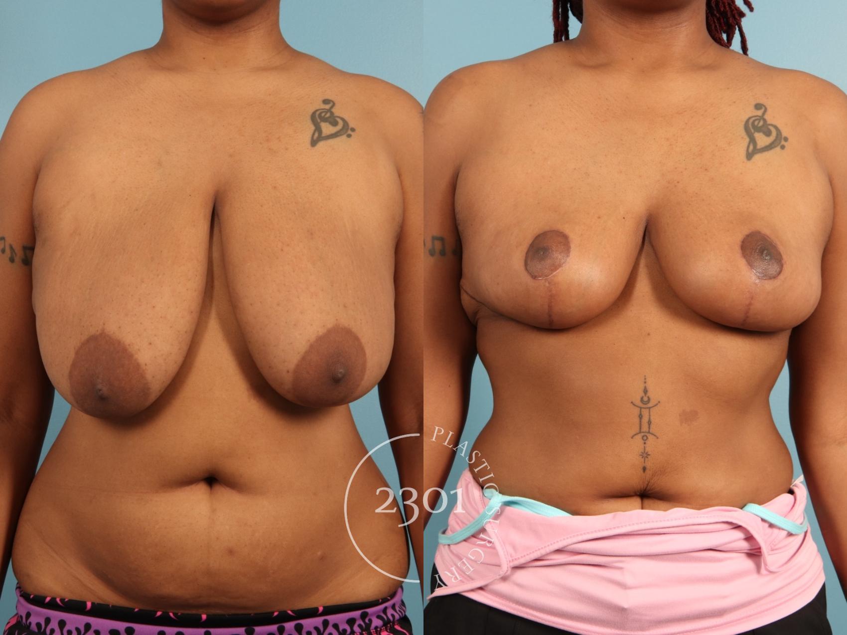 Before & After Breast Lift (Mastopexy) Case 972 Front View in Fort Worth, Plano, & Frisco, Texas