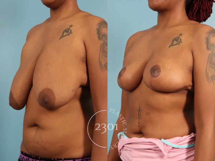 Before & After Breast Lift (Mastopexy) Case 972 Left Oblique View in Fort Worth, Plano, & Frisco, Texas