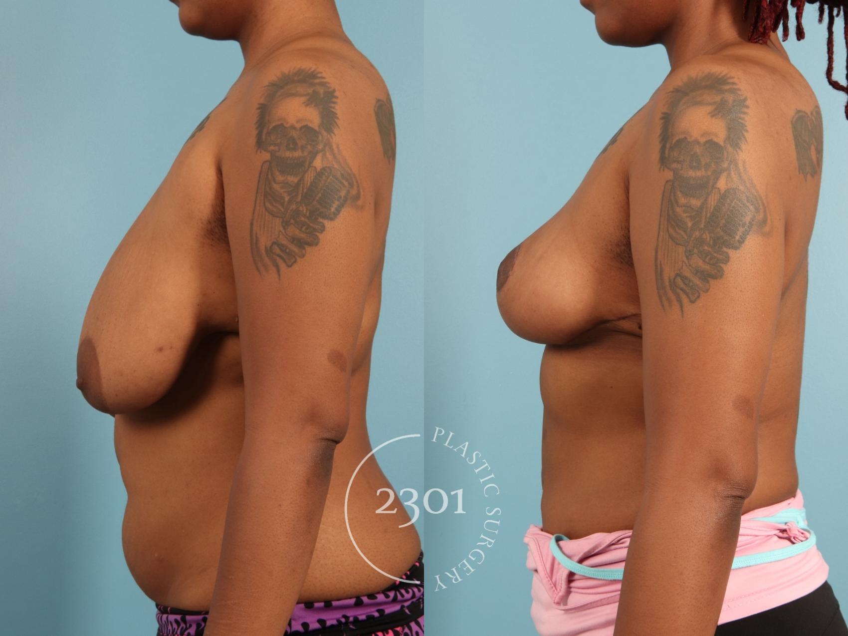 Before & After Breast Lift (Mastopexy) Case 972 Left Side View in Fort Worth, Plano, & Frisco, Texas