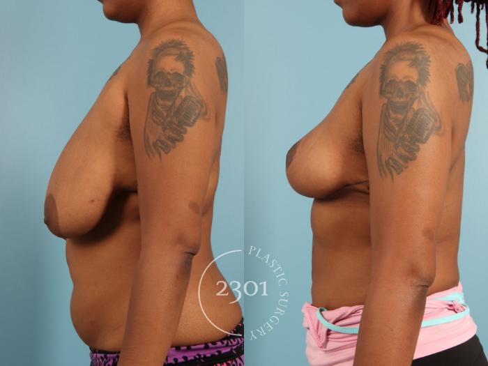 Before & After Breast Lift (Mastopexy) Case 972 Left Side View in Fort Worth, Plano, & Frisco, Texas