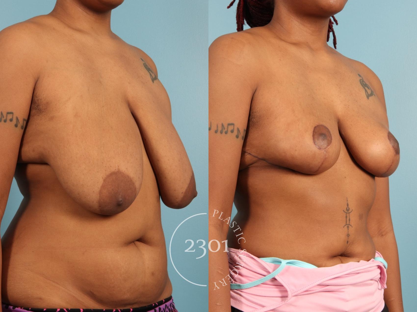 Before & After Breast Lift (Mastopexy) Case 972 Right Oblique View in Fort Worth, Plano, & Frisco, Texas