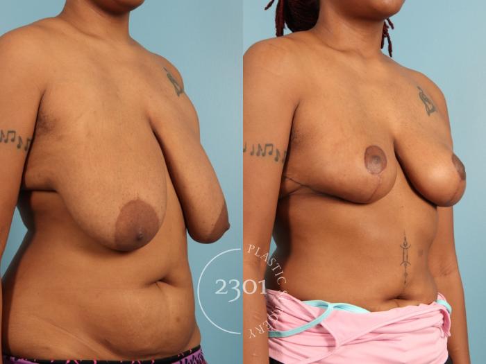 Before & After Breast Lift (Mastopexy) Case 972 Right Oblique View in Fort Worth, Plano, & Frisco, Texas