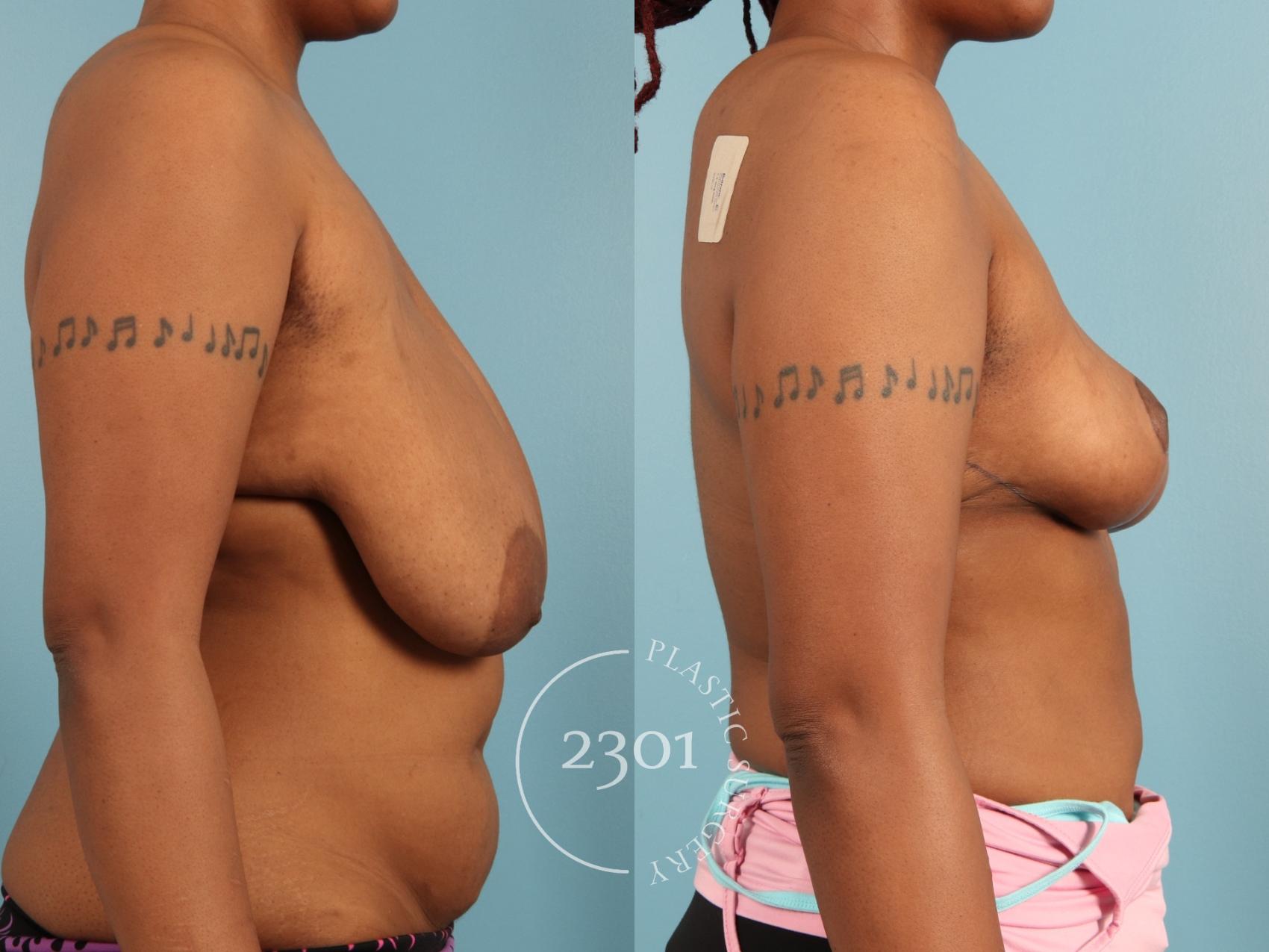 Before & After Breast Lift (Mastopexy) Case 972 Right Side View in Fort Worth, Plano, & Frisco, Texas