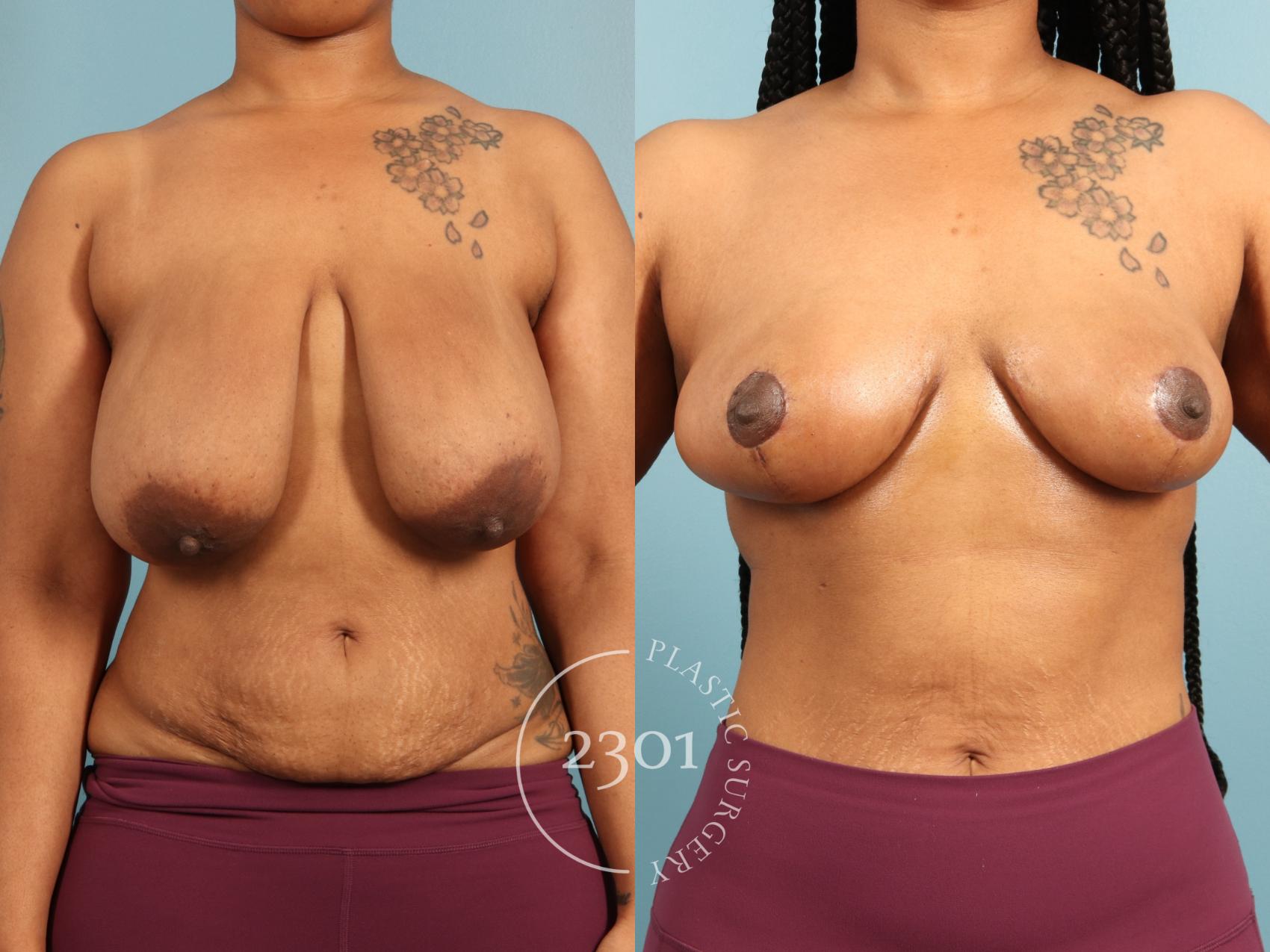 Before & After Breast Lift (Mastopexy) Case 973 Front View in Fort Worth, Plano, & Frisco, Texas