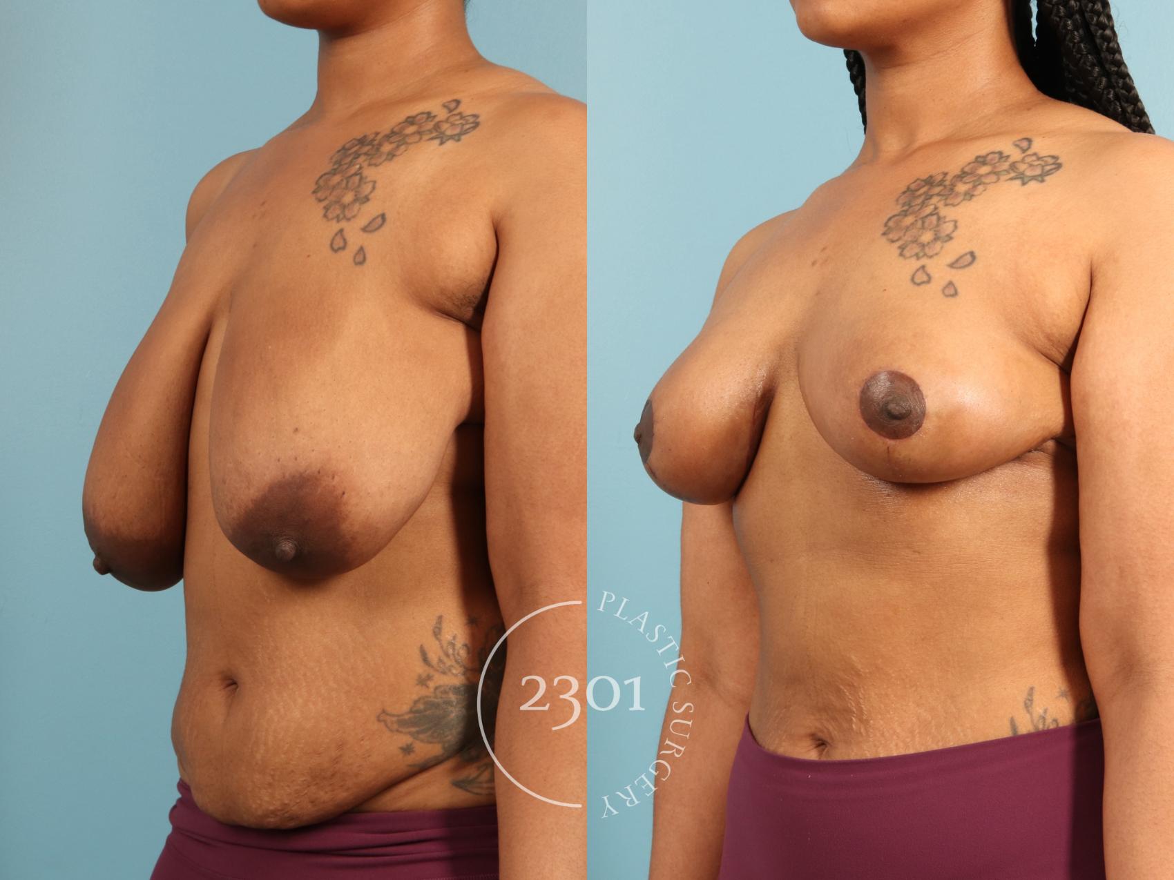 Before & After Breast Lift (Mastopexy) Case 973 Left Oblique View in Fort Worth, Plano, & Frisco, Texas