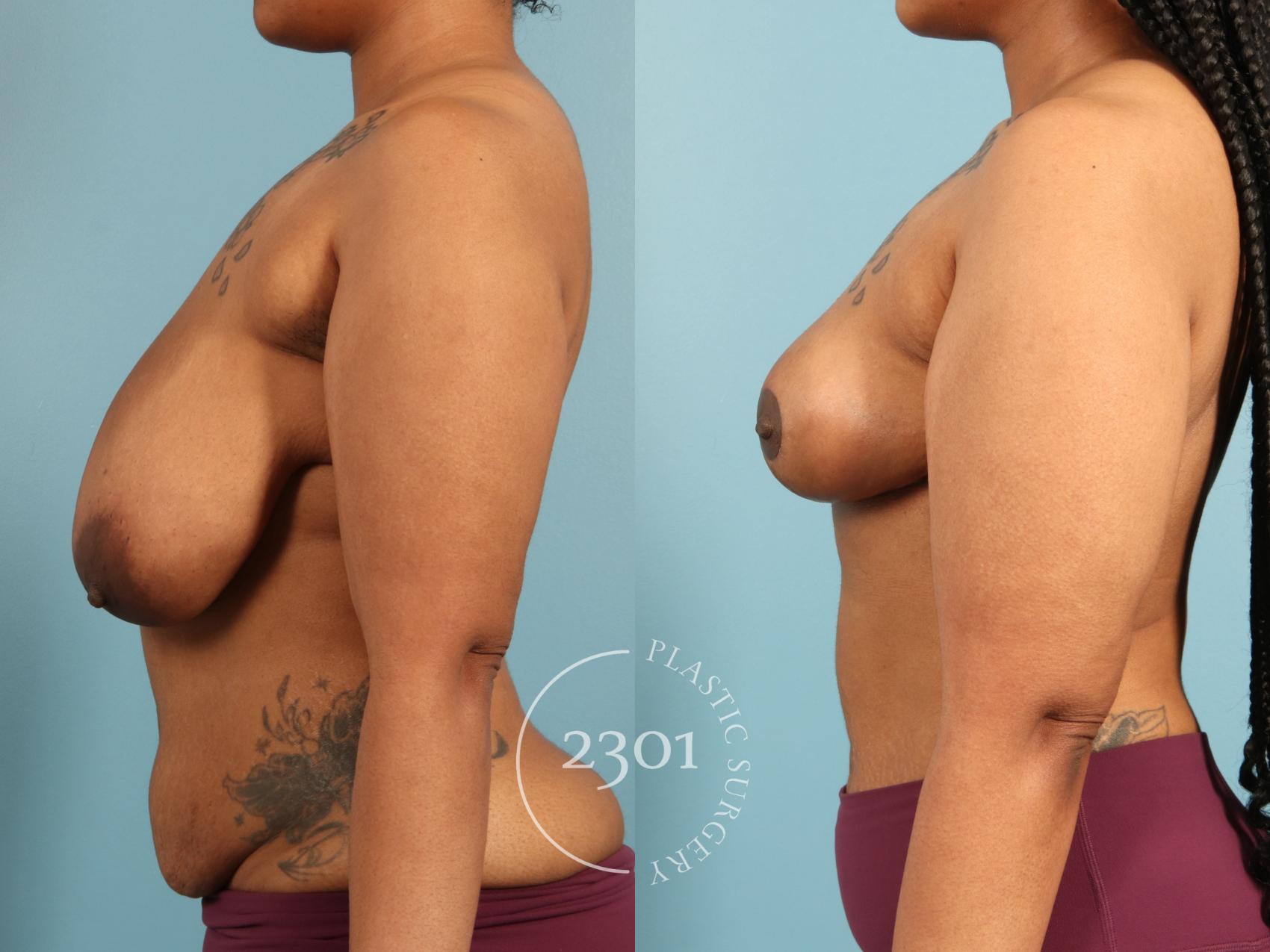 Before & After Breast Lift (Mastopexy) Case 973 Left Side View in Fort Worth, Plano, & Frisco, Texas