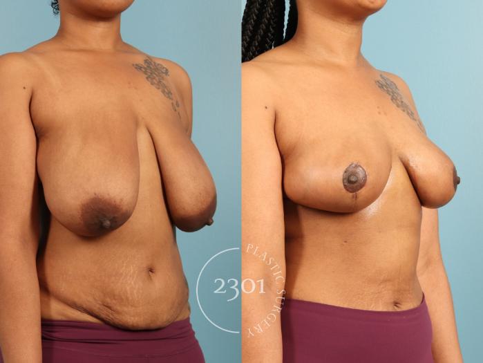Before & After Breast Lift (Mastopexy) Case 973 Right Oblique View in Fort Worth, Plano, & Frisco, Texas