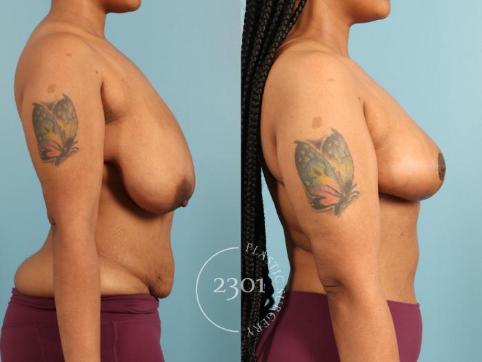 Before & After Breast Lift (Mastopexy) Case 973 Right Side View in Fort Worth, Plano, & Frisco, Texas