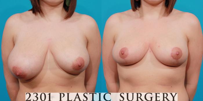 Before & After Breast Reduction Case 133 View #1 View in Fort Worth & Frisco, Texas