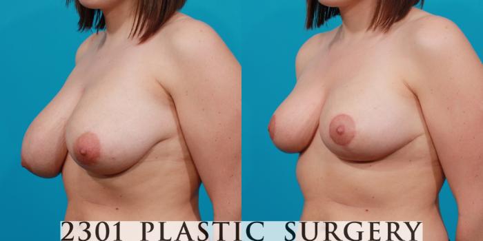 Before & After Breast Reduction Case 133 View #2 View in Fort Worth, Plano, & Frisco, Texas