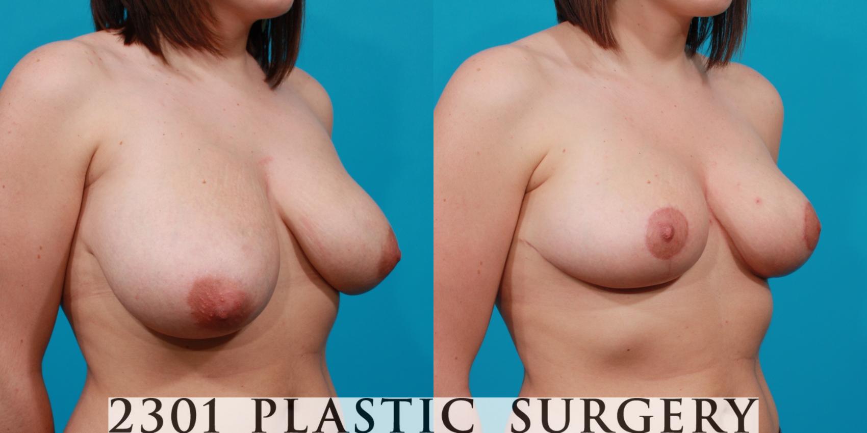 Before & After Breast Reduction Case 133 View #5 View in Fort Worth & Frisco, Texas