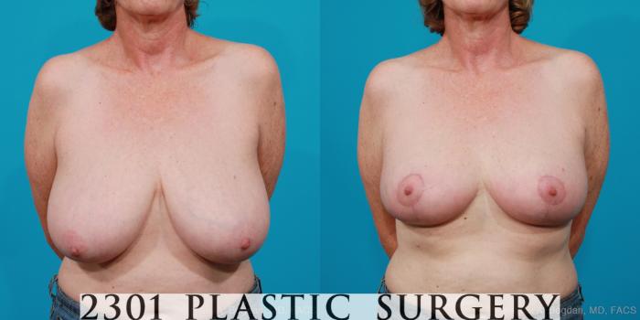 Before & After Breast Reduction Case 212 View #1 View in Fort Worth, Plano, & Frisco, Texas