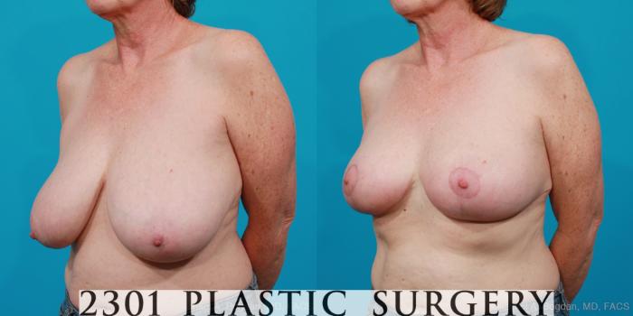 Before & After Breast Reduction Case 212 View #2 View in Fort Worth, Plano, & Frisco, Texas