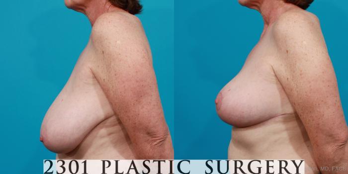 Before & After Breast Reduction Case 212 View #3 View in Fort Worth, Plano, & Frisco, Texas