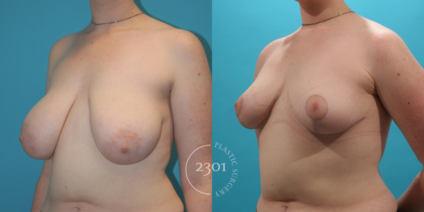 Before & After Breast Reduction Case 27 View #2 View in Fort Worth, Plano, & Frisco, Texas