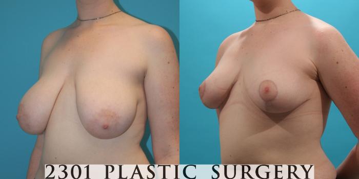 Before & After Breast Reduction Case 27 View #2 View in Fort Worth, Plano, & Frisco, Texas