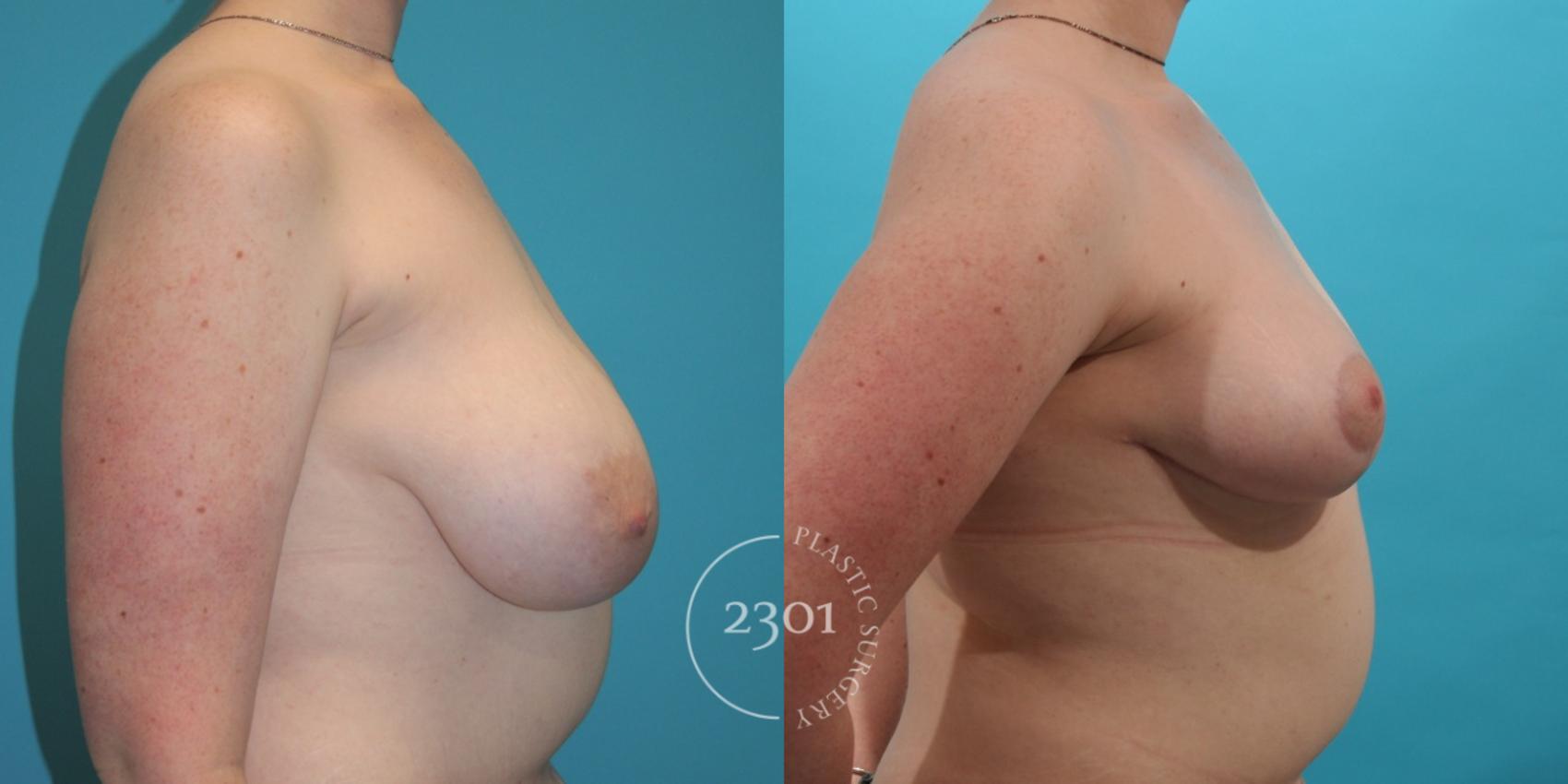 Before & After Breast Reduction Case 27 View #3 View in Fort Worth, Plano, & Frisco, Texas