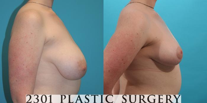 Before & After Breast Reduction Case 27 View #3 View in Fort Worth, Plano, & Frisco, Texas