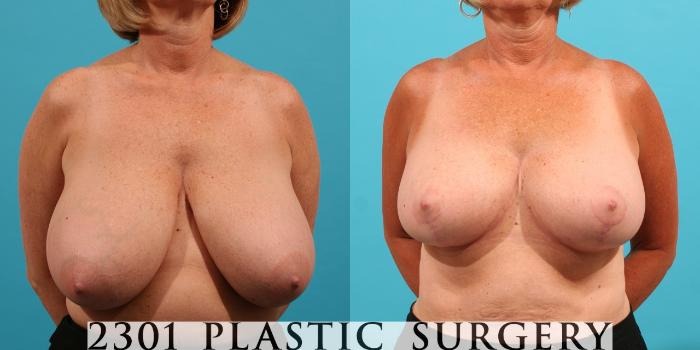 Before & After Breast Reduction Case 30 View #1 View in Fort Worth & Frisco, Texas