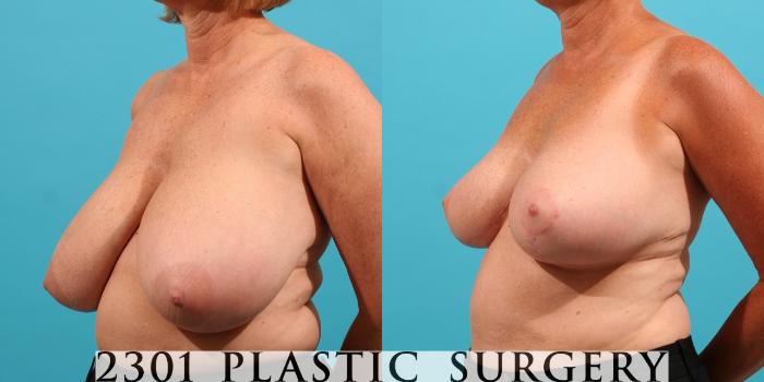 Before & After Breast Reduction Case 30 View #2 View in Fort Worth, Plano, & Frisco, Texas