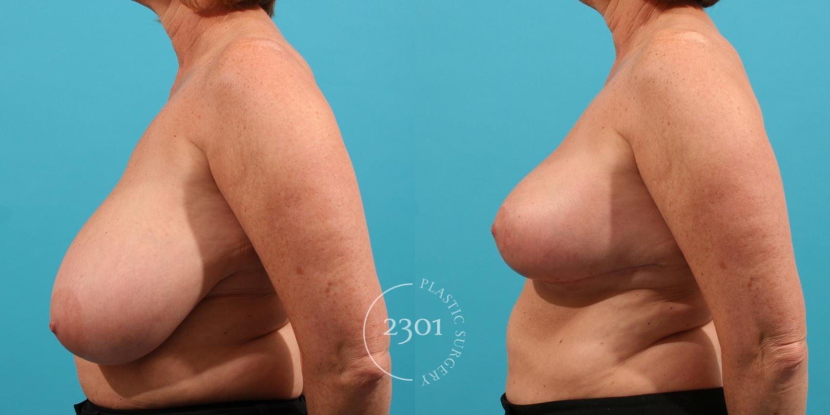Before & After Breast Reduction Case 30 View #3 View in Fort Worth, Plano, & Frisco, Texas