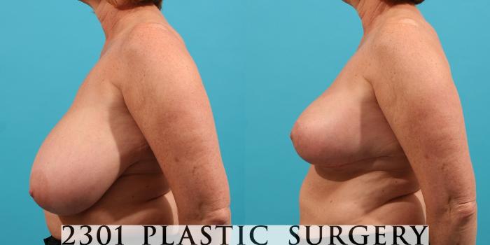 Before & After Breast Reduction Case 30 View #3 View in Fort Worth, Plano, & Frisco, Texas