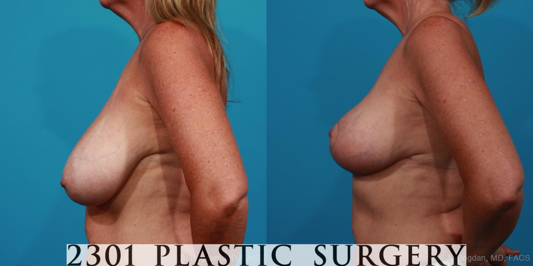 Before & After Breast Reduction Case 308 View #2 View in Fort Worth & Frisco, Texas