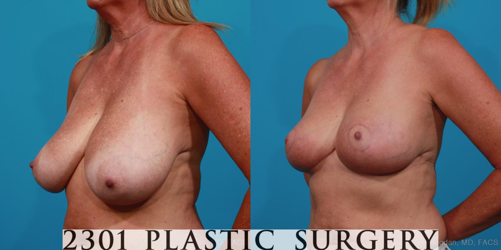 Before & After Breast Reduction Case 308 View #3 View in Fort Worth & Frisco, Texas