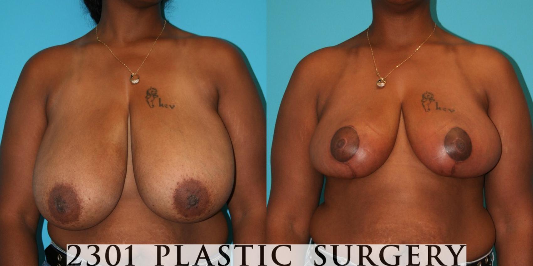 Before & After Breast Reduction Case 31 View #1 View in Fort Worth, Plano, & Frisco, Texas