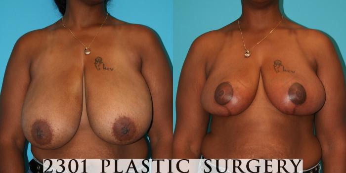Before & After Breast Reduction Case 31 View #1 View in Fort Worth & Frisco, Texas