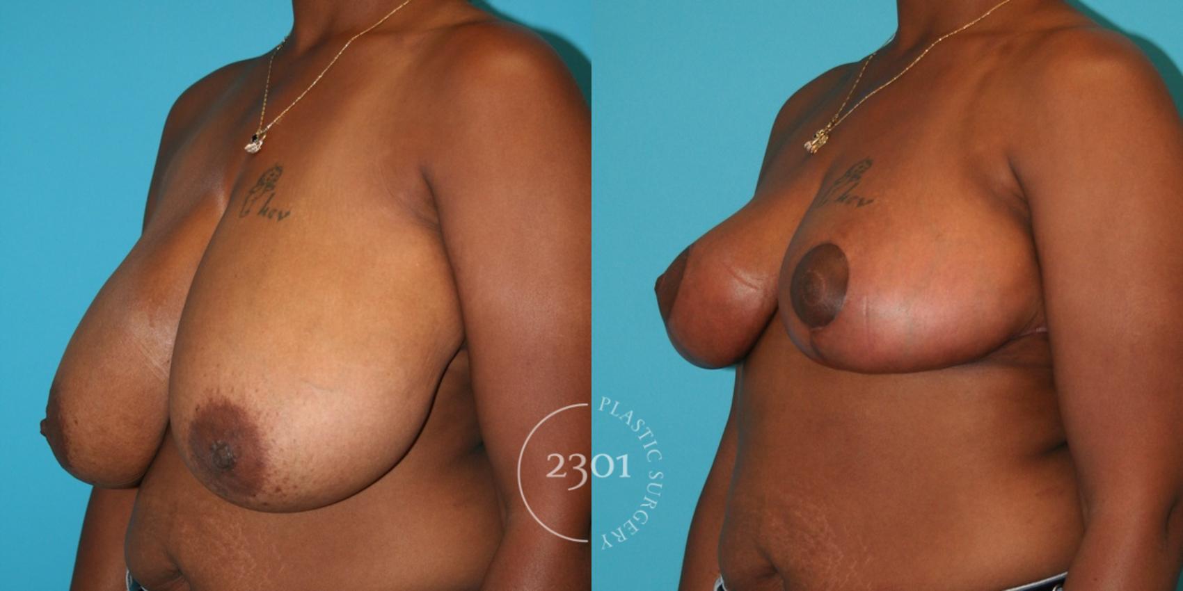 Before & After Breast Reduction Case 31 View #2 View in Fort Worth, Plano, & Frisco, Texas
